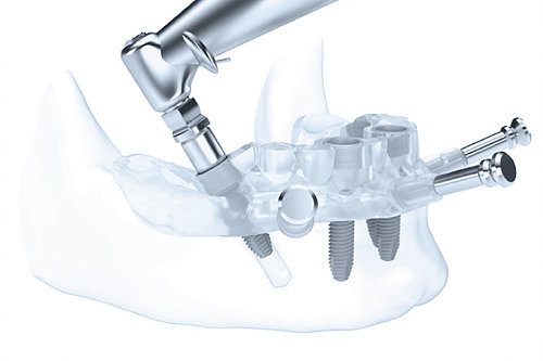 Cirugia Guiada de implantes dentales en Bilbao. Dentistas en Bilbao. Clinica Dental Nervion