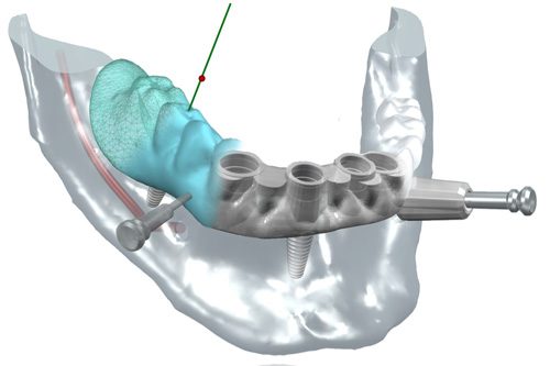 Cirugia Guiada de implantes dentales en Bilbao. Dentistas en Bilbao. Clinica Dental Nervion