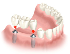 Soluciones Dentales por nuestros dentistas en Bilbao