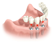 Soluciones Dentales por nuestros dentistas en Bilbao